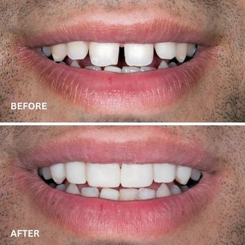 Before and after images showing a smile transformation through dental implants, highlighting improved tooth structure and aesthetics.