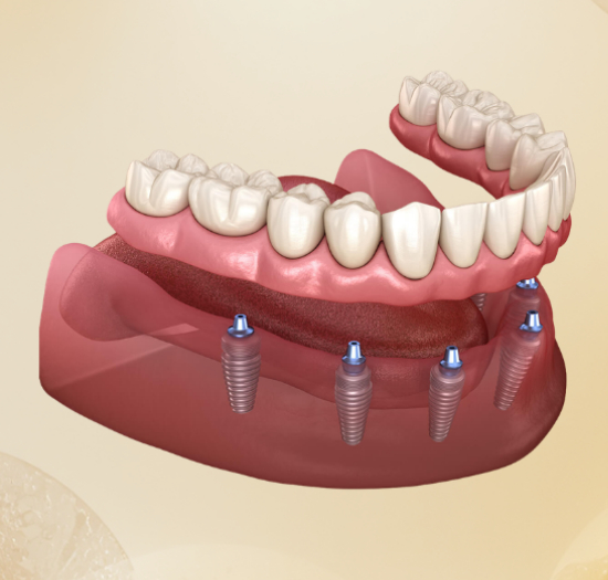 Illustration of dental implants and full-arch prosthesis, showcasing advanced restorative dentistry techniques for smile transformation at NuSmile Implant Studio.