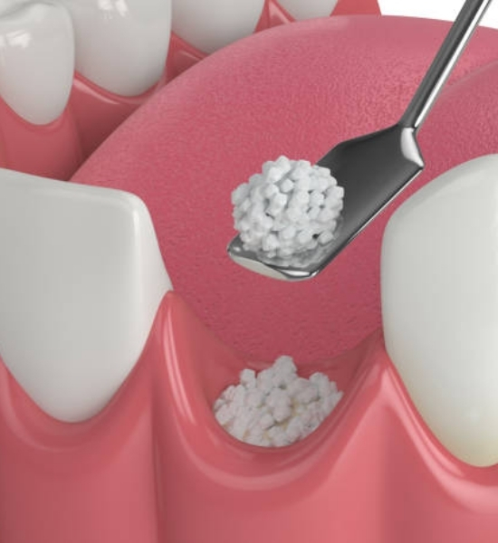 Bone grafting procedure with a dental tool placing graft material into jawbone area, highlighting restoration of bone density for dental implants.