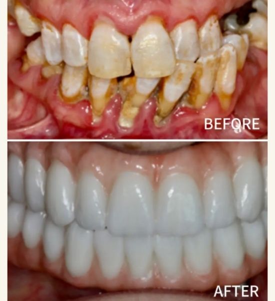 Before and after images of complex dental restoration, showcasing significant improvement in tooth appearance and alignment, emphasizing advanced restorative dentistry and patient transformation at NuSmile Implant Studio.