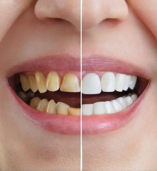 Before and after comparison of teeth whitening, showcasing yellowed teeth on the left and bright white teeth on the right, emphasizing cosmetic dentistry results.