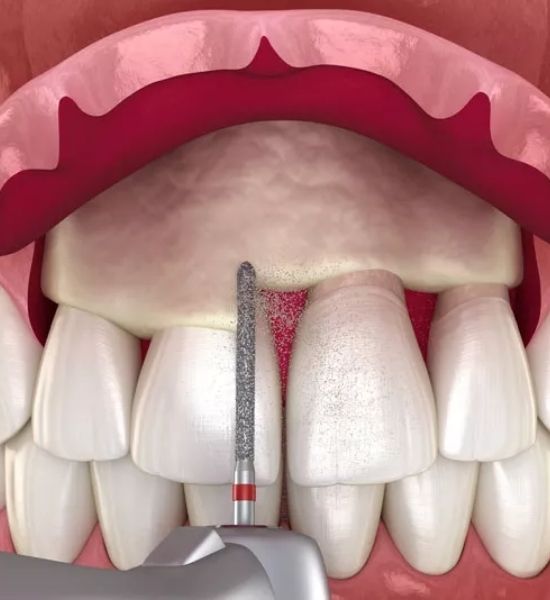 Illustration of dental crown lengthening procedure, showing dental tool reshaping gum tissue around front teeth to expose more tooth structure for restorative and aesthetic purposes.