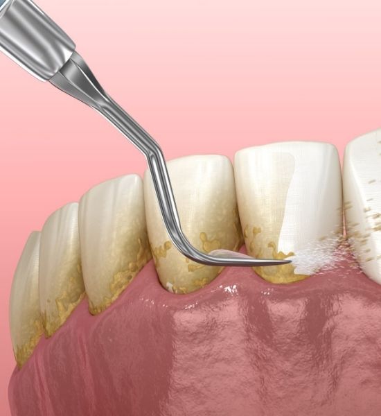 Dental instrument performing deep cleaning on teeth, removing plaque and tartar buildup below gumline to promote oral health and manage gum disease.