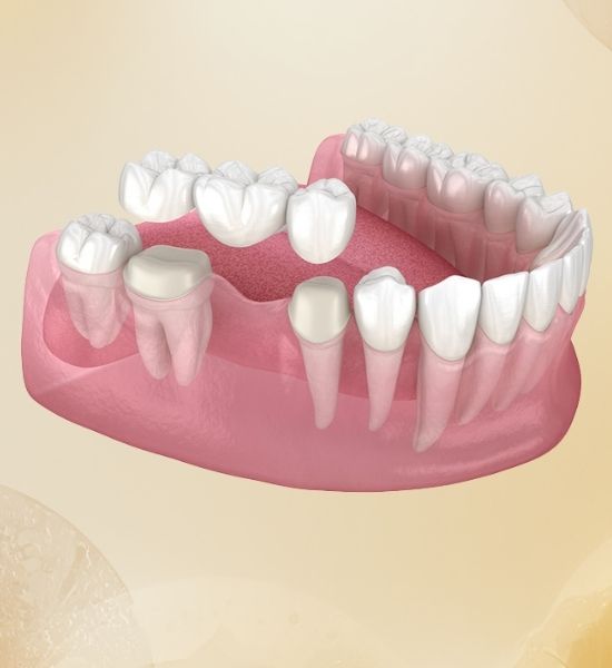 3D illustration of dental bridge structure, showcasing replacement teeth anchored to adjacent natural teeth, emphasizing restoration of oral function and aesthetics.