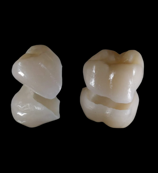 Dental crowns showcasing advanced ceramic materials, designed for durability and natural appearance, highlighting restorative dental solutions at NuSmile Implant Studio.