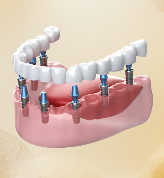 Dental implant model showcasing full-arch restoration with multiple implants and prosthetic teeth, illustrating advanced implant dentistry techniques at NuSmile Implant Studio.