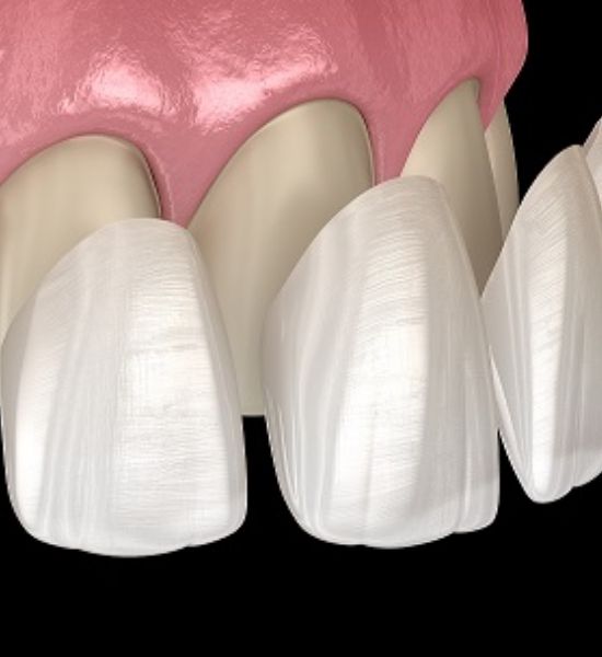 Dental veneers applied to front teeth, showcasing enhanced shape and color, with pink gum tissue visible, emphasizing cosmetic dentistry benefits at NuSmile Implant Studio.