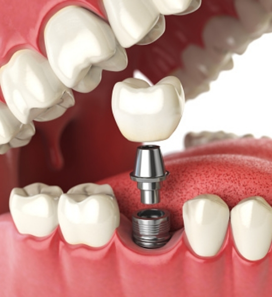 Dental implant procedure illustration showing titanium post and custom crown placement in the mouth.