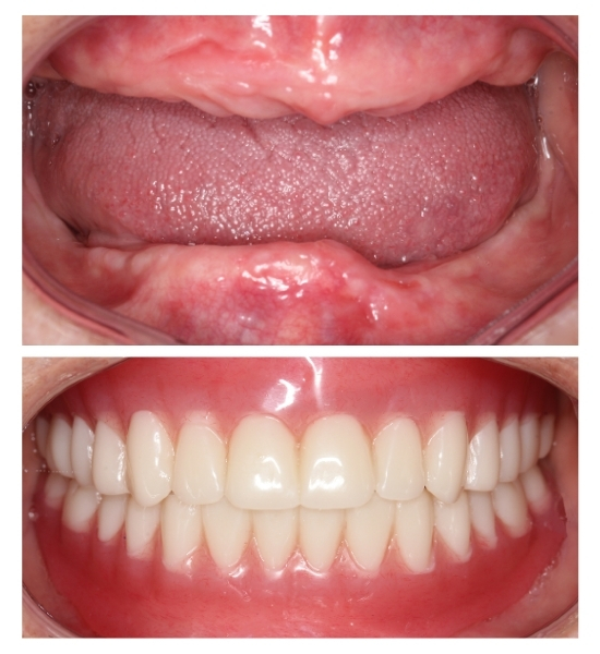 Full dentures in a clinical setting, showcasing upper and lower arches, demonstrating restoration of natural appearance and function for patients missing teeth.