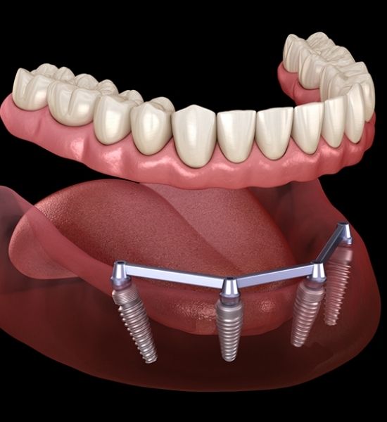 Full mouth implants illustration showing implant-supported restoration with dental arch and underlying structure, emphasizing stability and aesthetics for comprehensive dental solutions.