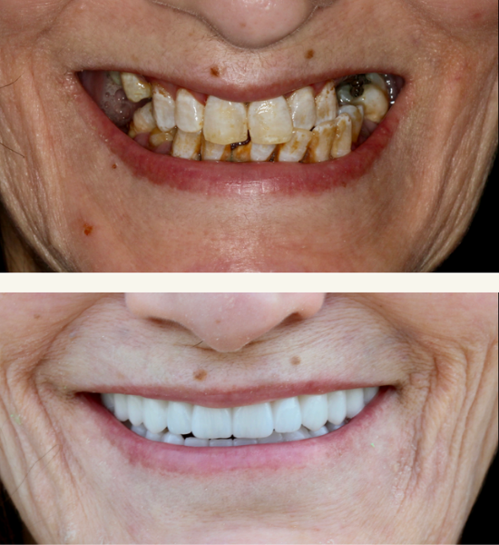 Before and after images of full mouth rehabilitation showcasing significant dental transformation, highlighting restored aesthetics and function with a focus on implant-supported restorations.