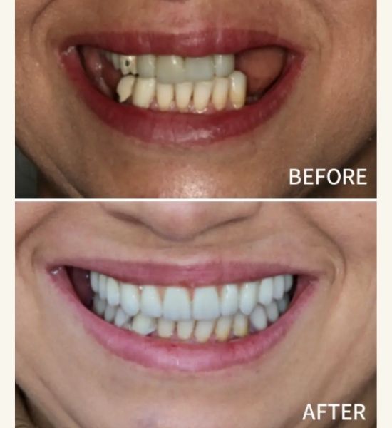 Full Mouth reconstruction | Full Mouth Reconstruction Beverly Chicago, IL | NuSmile Implant Studio