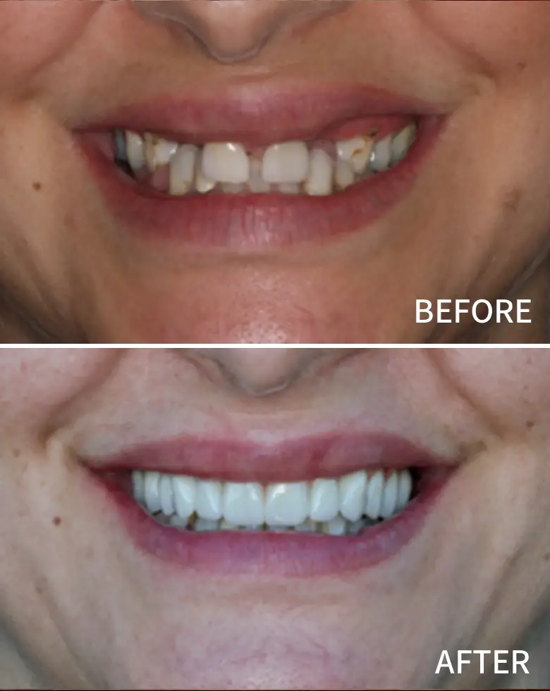 Before-and-after image of a smile transformation showcasing full mouth rehabilitation, highlighting improvements in tooth alignment, color, and overall aesthetics, addressing anterior tooth loss and malocclusion.