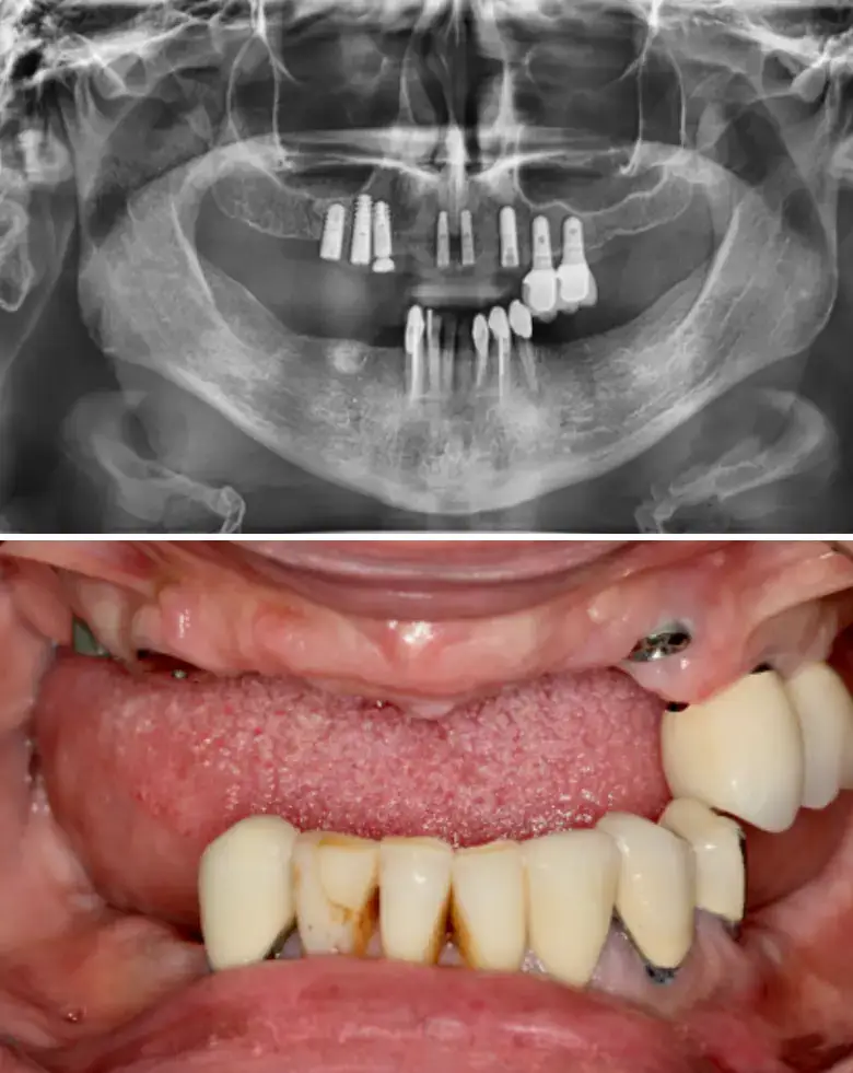 X-ray image showing dental implants and oral cavity with restored teeth, illustrating full mouth rehabilitation for anterior tooth loss and malocclusion.