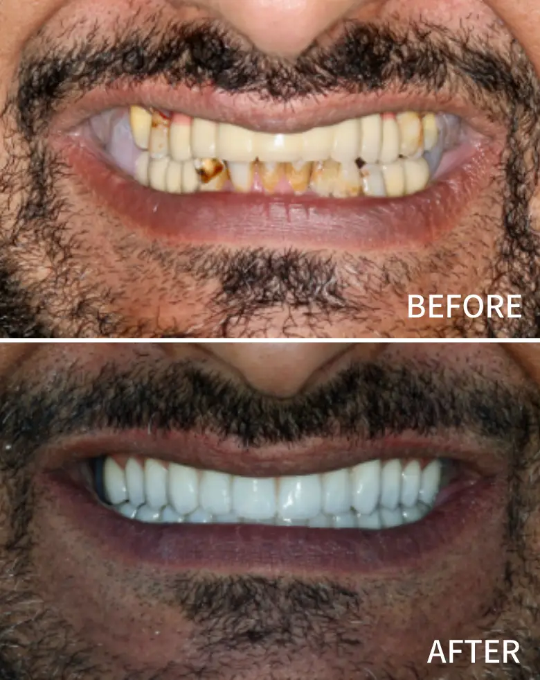 Before-and-after image of a full mouth rehabilitation, showcasing significant improvement in dental aesthetics, highlighting tooth restoration and enhanced smile appearance.