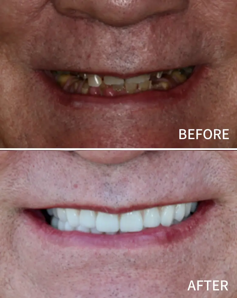 Before-and-after image of a full mouth rehabilitation showcasing significant dental transformation, highlighting improved aesthetics and alignment of anterior teeth, addressing issues of diastema and tooth wear.