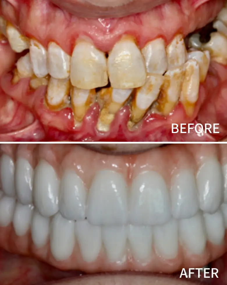 Before-and-after image of a full mouth rehabilitation showcasing significant dental transformation, highlighting improvements from anterior tooth loss, generalized tooth wear, and malocclusion to a restored, bright smile.