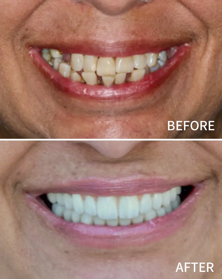 Before-and-after image showcasing full mouth rehabilitation, highlighting significant transformation in tooth alignment and color, addressing diastema and anterior tooth loss.