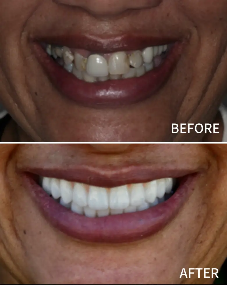 Before-and-after image showcasing a smile transformation, highlighting improvements in tooth alignment, restoration of anterior teeth, and overall cosmetic enhancement related to full mouth rehabilitation.
