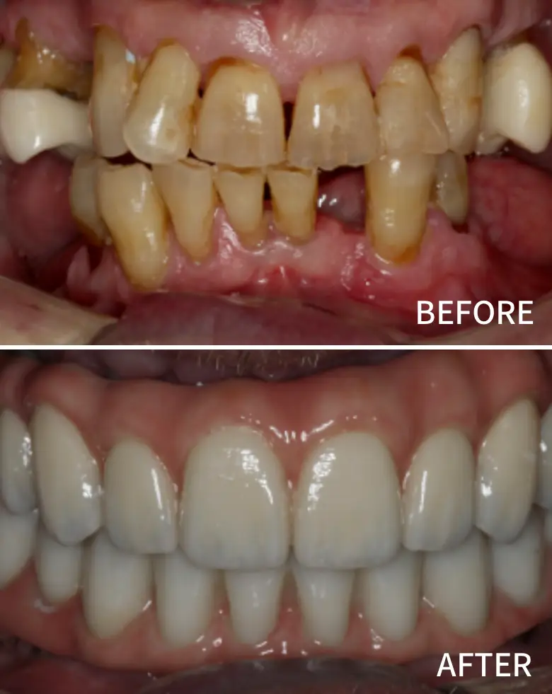 Before-and-after image of a full mouth rehabilitation showcasing significant transformation in dental aesthetics, featuring improved tooth alignment, color, and restoration of anterior teeth.
