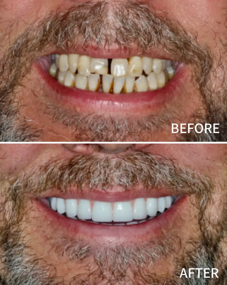Before-and-after image of a smile transformation showcasing significant improvement in dental aesthetics, addressing issues like diastema, tooth discoloration, and alignment for full mouth rehabilitation.