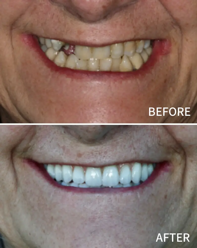 Before-and-after image of a smile transformation, showcasing full mouth rehabilitation, addressing anterior tooth loss, diastema, and cosmetic enhancements at NuSmile Implant Studio.