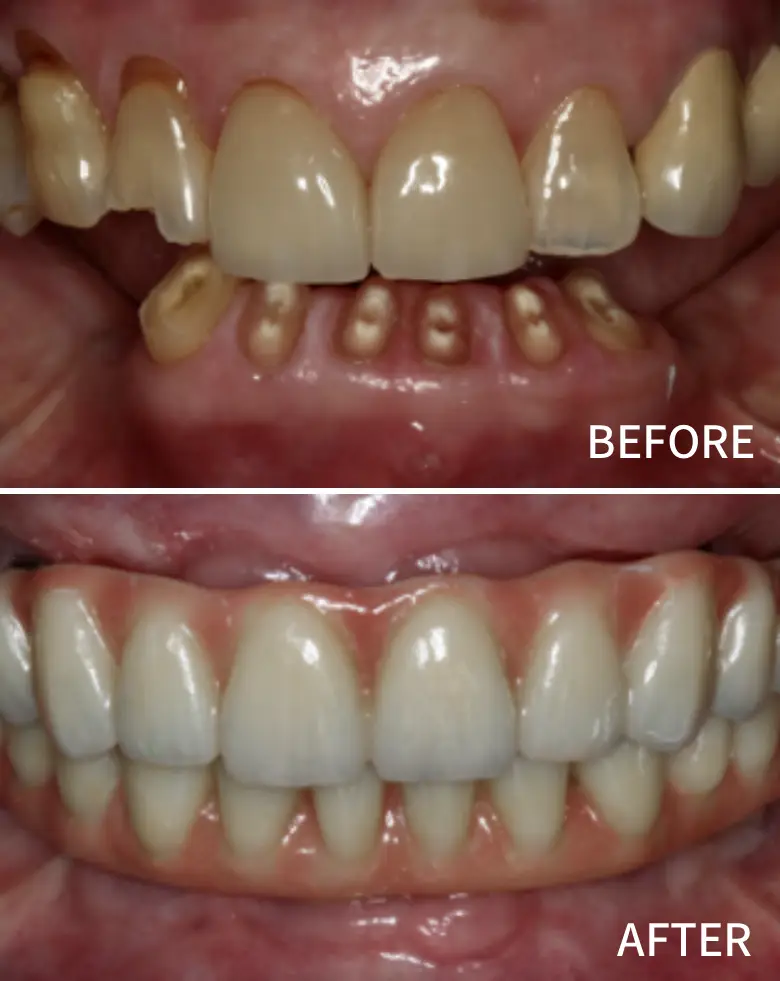 Before-and-after image of a full mouth rehabilitation showcasing significant dental transformation, addressing anterior tooth loss, diastema, and overall cosmetic enhancement.