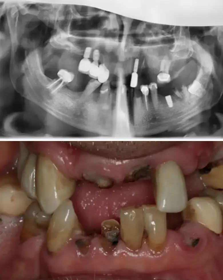 X-ray image showing dental implants and close-up of anterior teeth with decay and restorations, illustrating full mouth rehabilitation for smile transformation.