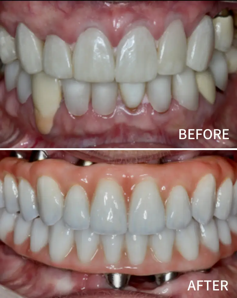 Before and after image of a full mouth rehabilitation showcasing improved smile aesthetics, highlighting resolution of diastema and anterior tooth loss with restored tooth alignment and color.