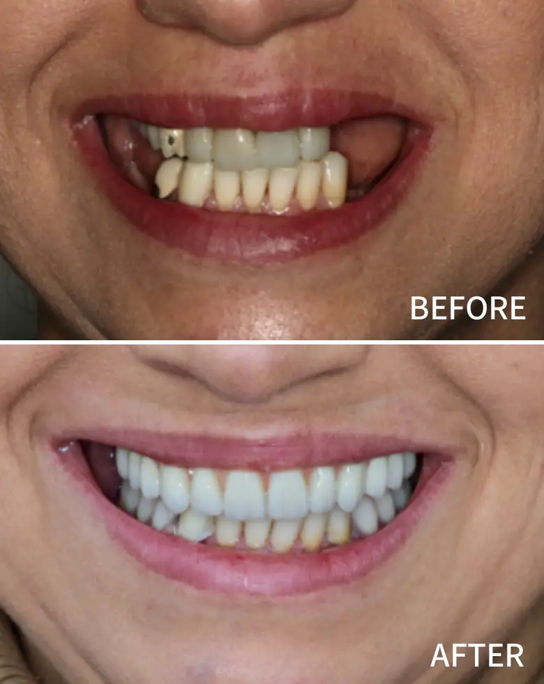 Before-and-after image showcasing a full mouth rehabilitation, highlighting transformation from anterior tooth loss and generalized tooth wear to a restored, bright smile.