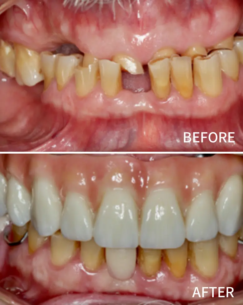 Before-and-after image of full mouth rehabilitation showcasing significant dental transformation, highlighting anterior tooth loss, diastema correction, and improved tooth aesthetics.