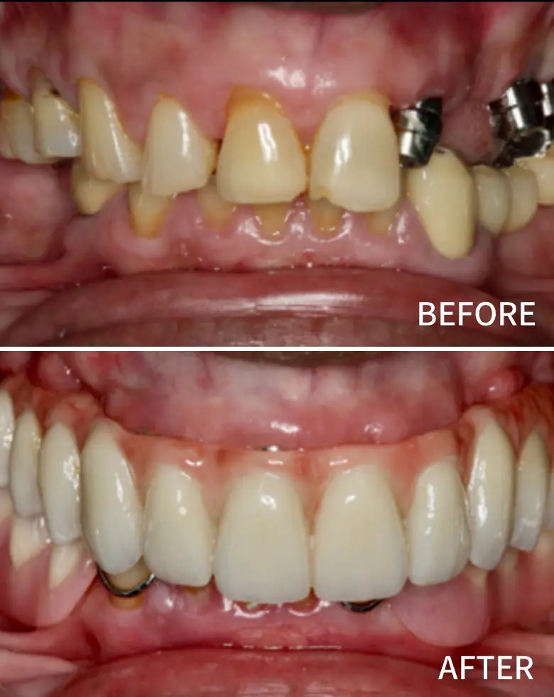 Before-and-after image of full mouth rehabilitation showcasing significant improvement in tooth alignment, restoration of anterior teeth, and resolution of malocclusion issues.