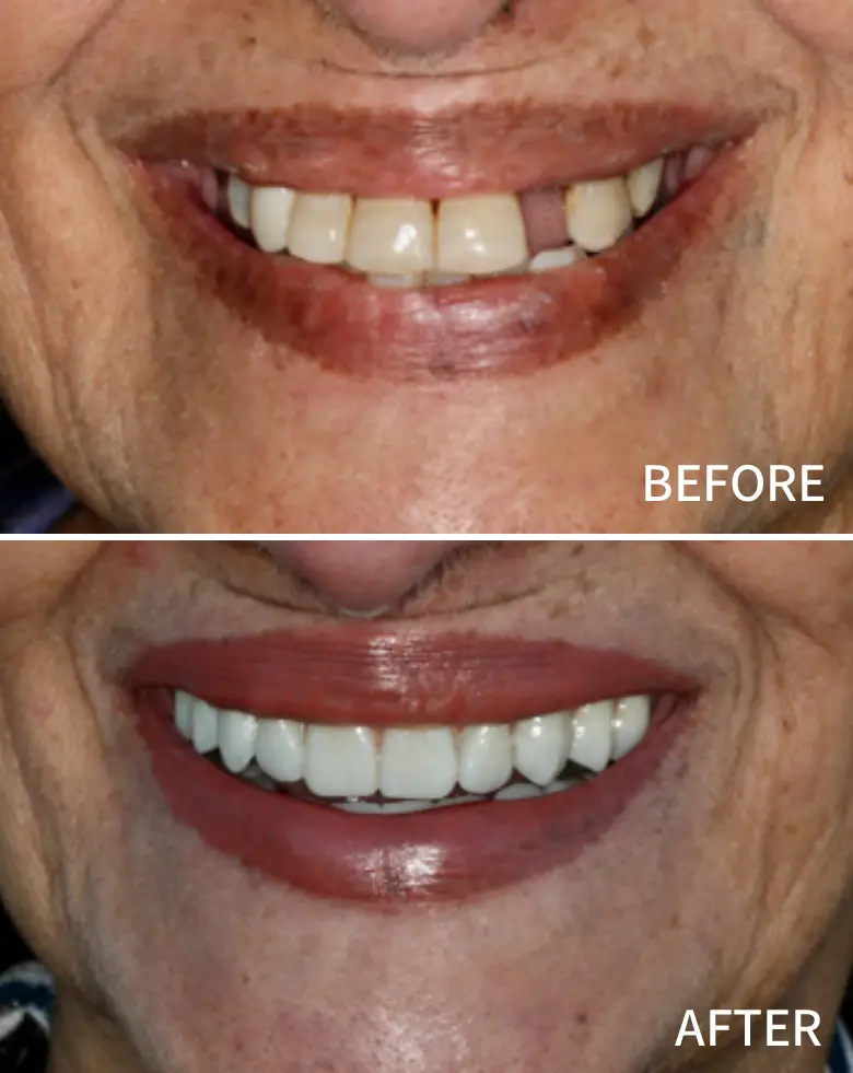 Before-and-after image of a smile transformation showcasing full mouth rehabilitation, highlighting improved tooth alignment and aesthetics, addressing issues like diastema and anterior tooth loss.