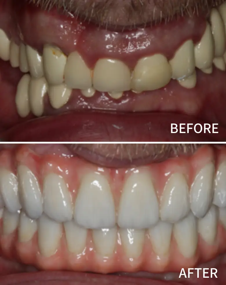Before-and-after dental transformation showcasing full mouth rehabilitation, highlighting improved tooth alignment and aesthetics, addressing issues like diastema and anterior tooth loss.
