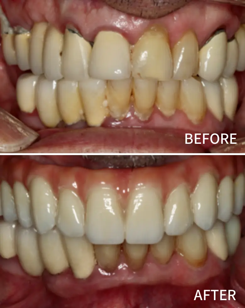 Before-and-after image of a full mouth rehabilitation showcasing significant dental transformation, addressing issues like diastema, anterior tooth loss, and generalized tooth wear.