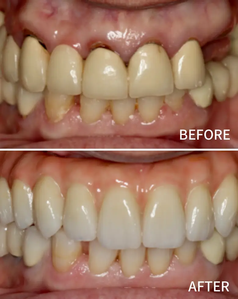 Before-and-after image of a full mouth rehabilitation, showcasing significant dental transformation with improved tooth alignment, restoration of anterior teeth, and correction of malocclusion.