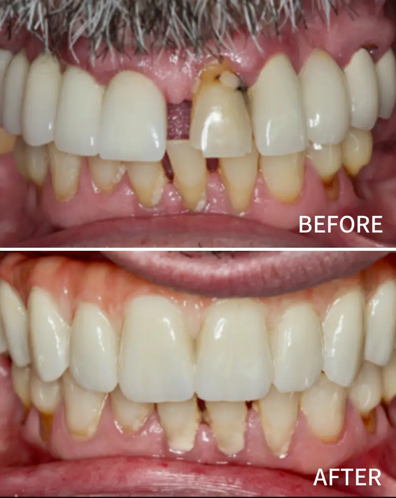 Before-and-after image of a full mouth rehabilitation showcasing significant improvement in tooth appearance, addressing anterior tooth loss, diastema, and generalized tooth wear.