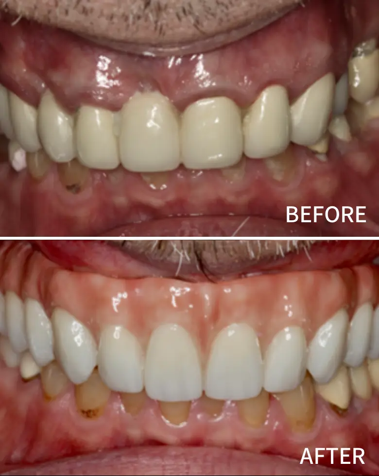 Before-and-after image of full mouth rehabilitation showcasing dental transformation, highlighting anterior tooth loss, diastema correction, and improved aesthetics at NuSmile Implant Studio.