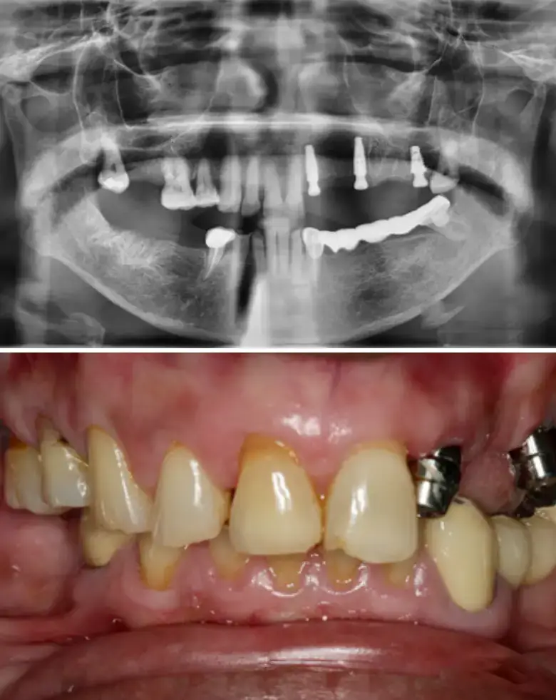 X-ray image showing dental implants and full mouth rehabilitation, highlighting anterior tooth loss and multiple failing restorations.