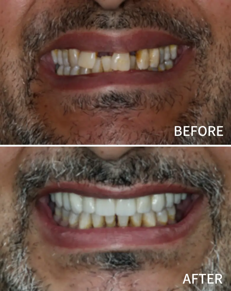 Before-and-after image of a man's smile transformation, showcasing significant improvement in tooth alignment, color, and overall aesthetics, addressing issues like diastema and anterior tooth loss.