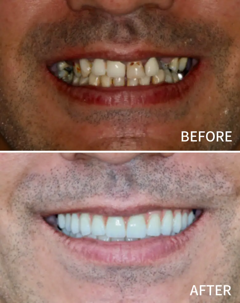 Before-and-after image of a smile transformation, showcasing significant improvement in dental aesthetics, addressing issues like anterior tooth loss, discoloration, and malocclusion, relevant to full mouth rehabilitation at NuSmile Implant Studio.
