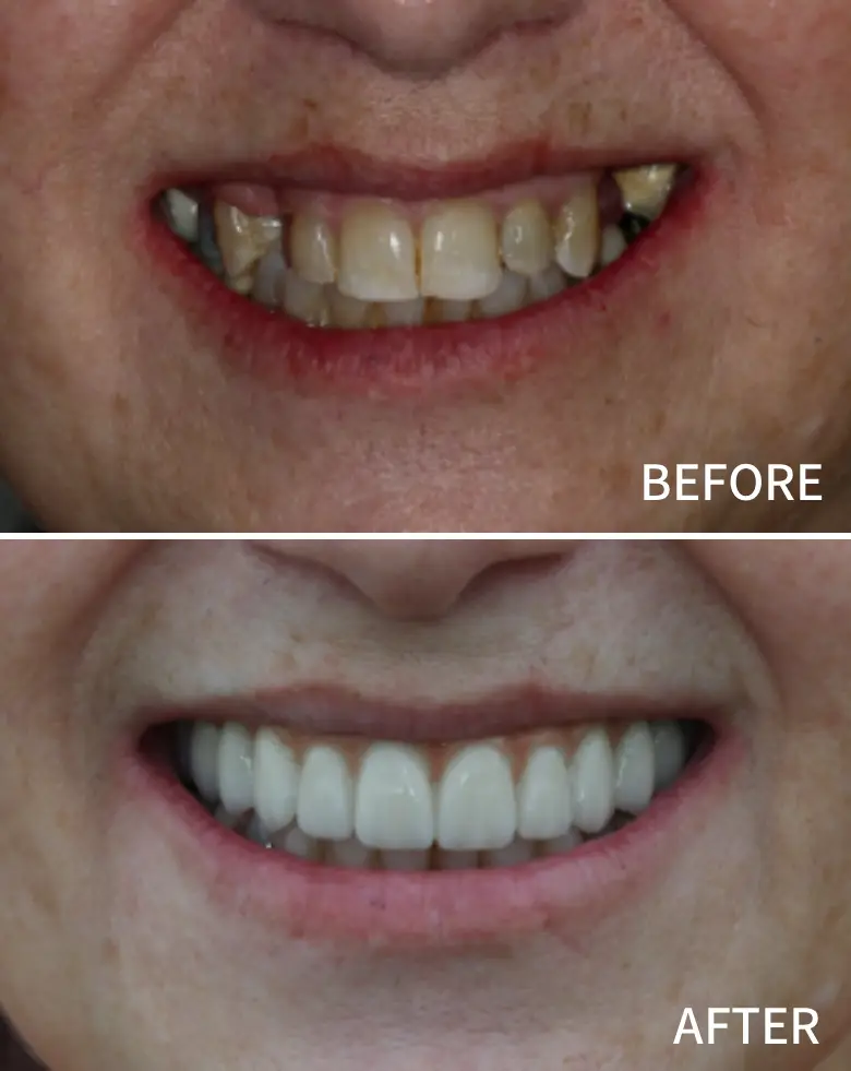 Before-and-after images of full mouth rehabilitation showcasing significant dental transformation, highlighting anterior tooth restoration and improved smile aesthetics.