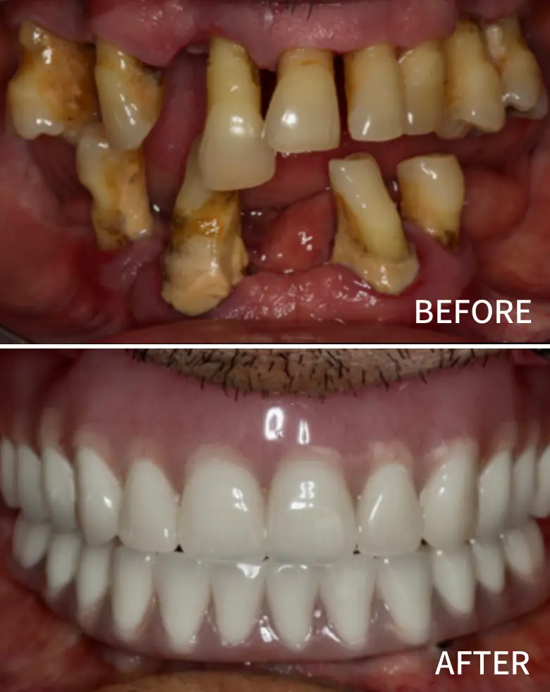 Before-and-after image of full mouth rehabilitation, showcasing significant dental transformation from decayed and missing teeth to a complete set of bright, healthy teeth.