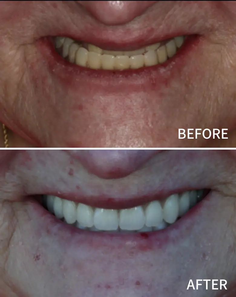 Before-and-after image of a full mouth rehabilitation showcasing significant dental transformation, addressing anterior tooth loss and malocclusion, highlighting improved smile aesthetics.