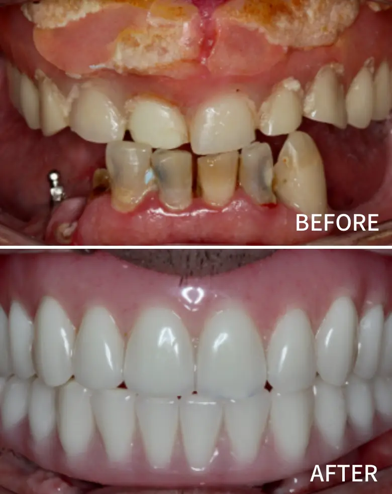 Before-and-after image of full mouth rehabilitation showcasing significant dental transformation, addressing anterior tooth loss, diastema, and generalized tooth wear, with improved aesthetics and alignment.