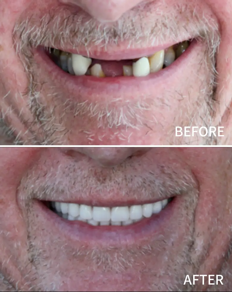 Before-and-after comparison of a man's smile transformation, showcasing significant improvement in tooth alignment and color, addressing issues like anterior tooth loss and malocclusion, relevant to full mouth rehabilitation.