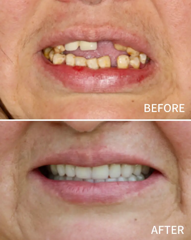 Before-and-after dental transformation showcasing significant improvement in smile aesthetics, addressing issues like diastema, anterior tooth loss, and generalized tooth wear through full mouth rehabilitation at NuSmile Implant Studio.
