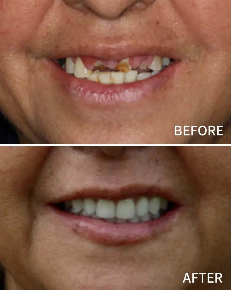 Before-and-after image of a full mouth rehabilitation, showcasing significant dental transformation, including correction of anterior tooth loss, improved alignment, and enhanced smile aesthetics.