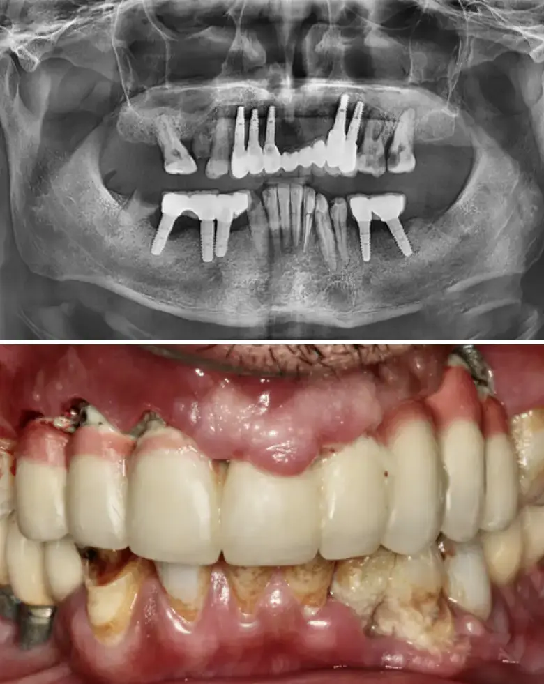 Full mouth rehabilitation before and after images showing dental implants and restored teeth, addressing diastema, anterior tooth loss, and multiple failing restorations.