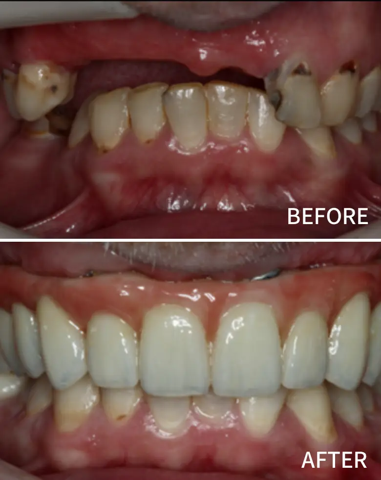Before-and-after image of full mouth rehabilitation showcasing significant dental transformation, addressing anterior tooth loss, diastema, and multiple failing restorations, highlighting improved aesthetics and functionality.